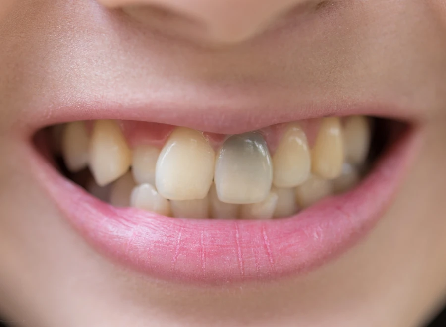 coloration dents traitement coloration dents traitementColoration des dentsDrs BLUCHE & MONTANARO | Dentistes Lézignan-Corbières
