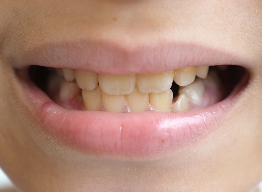 dents colorees dentiste traitement dents colorees dentiste traitementColoration des dentsDrs BLUCHE & MONTANARO | Dentistes Lézignan-Corbières