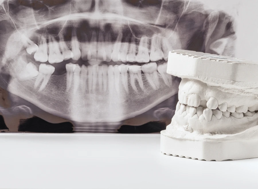 perte dents dentiste bluche lezignan corbieres perte dents dentiste bluche lezignan corbieresPerte de dentsDrs BLUCHE & MONTANARO | Dentistes Lézignan-Corbières