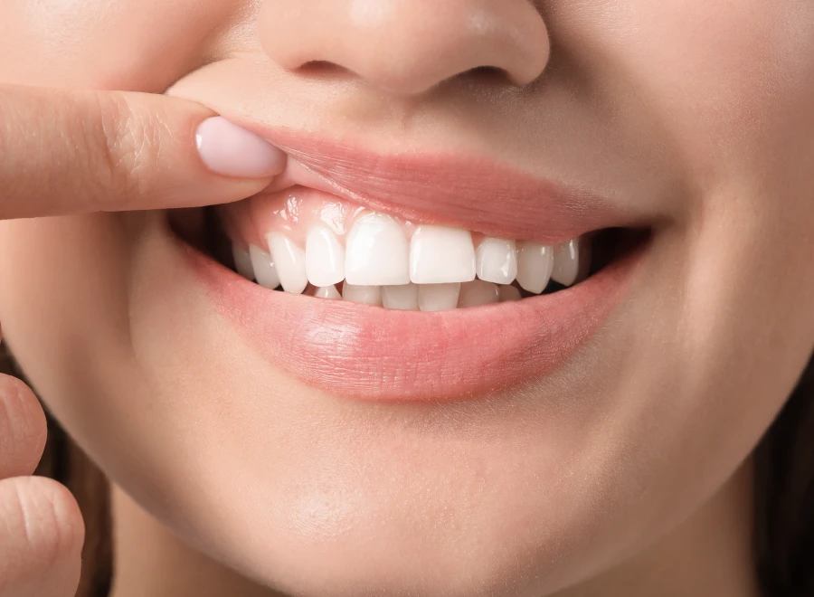 chirurgiens dentistes lezignan facettes chirurgiens dentistes lezignan facettesGreffe de genciveDrs BLUCHE & MONTANARO | Dentistes Lézignan-Corbières