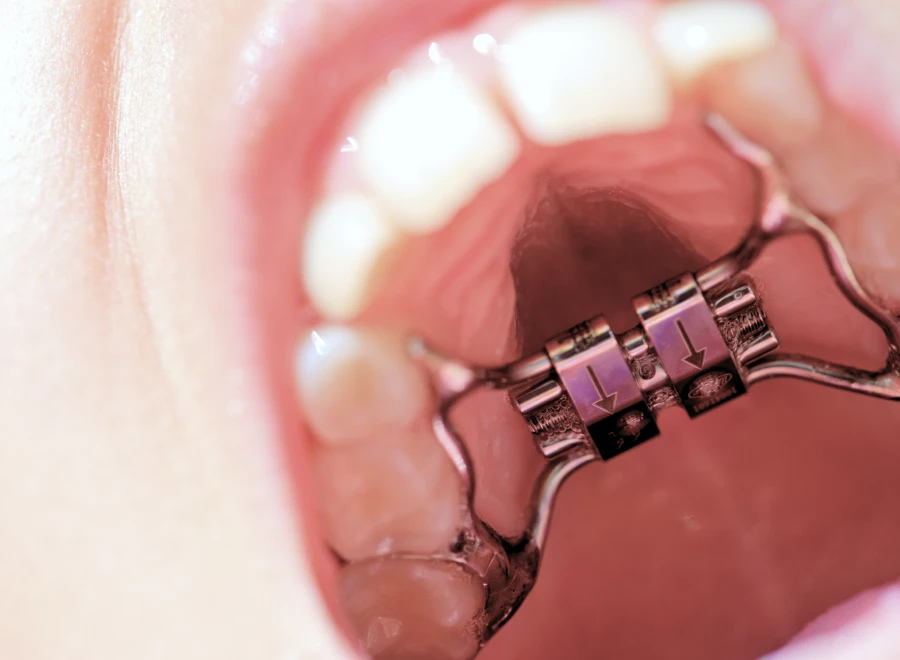 disjoncteur orthodontie enfant docteur montanaro disjoncteur orthodontie enfant docteur montanaroDisjoncteurDrs BLUCHE & MONTANARO | Dentistes Lézignan-Corbières