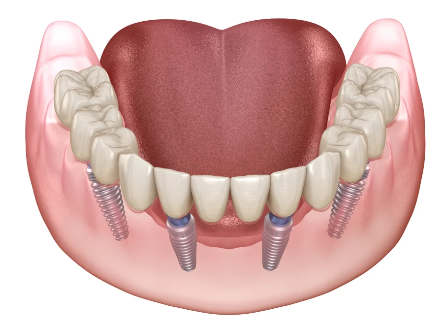 all on dentsite bluche all on dentsite blucheAll-on 4 / All-on 6Drs BLUCHE & MONTANARO | Dentistes Lézignan-Corbières
