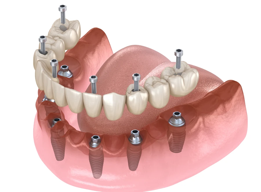 all on dentiste bluche all on dentiste blucheAll-on 4 / All-on 6Drs BLUCHE & MONTANARO | Dentistes Lézignan-Corbières