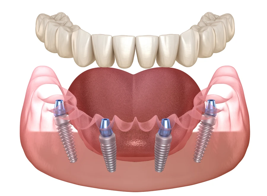 all on implant lezignan corbieres all on implant lezignan corbieresAll-on 4 / All-on 6Drs BLUCHE & MONTANARO | Dentistes Lézignan-Corbières