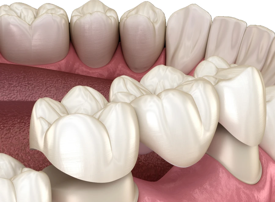 bridge dentaire dentiste lezignan corbieres bridge dentaire dentiste lezignan corbieresProthèses fixesDrs BLUCHE & MONTANARO | Dentistes Lézignan-Corbières