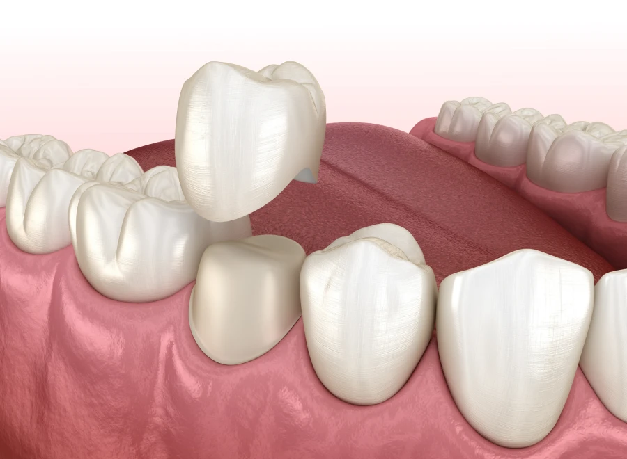 couronne dentaire dentiste lezignan corbieres couronne dentaire dentiste lezignan corbieresProthèses fixesDrs BLUCHE & MONTANARO | Dentistes Lézignan-Corbières
