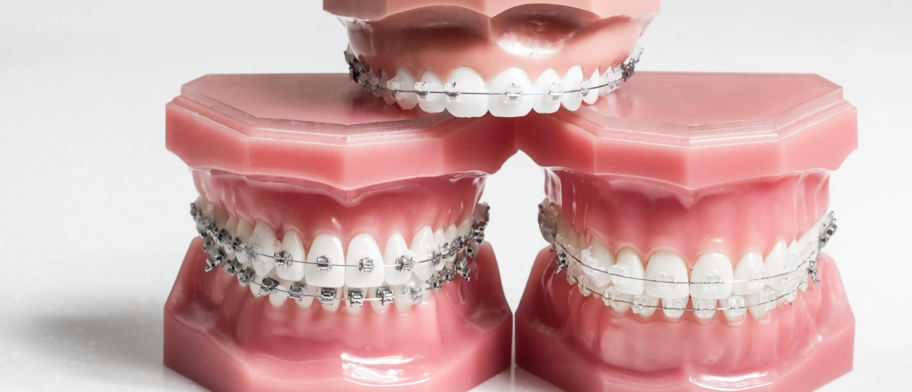 drs bluche montanaro drs bluche montanaroTraitement par multi-baguesDrs BLUCHE & MONTANARO | Dentistes Lézignan-Corbières