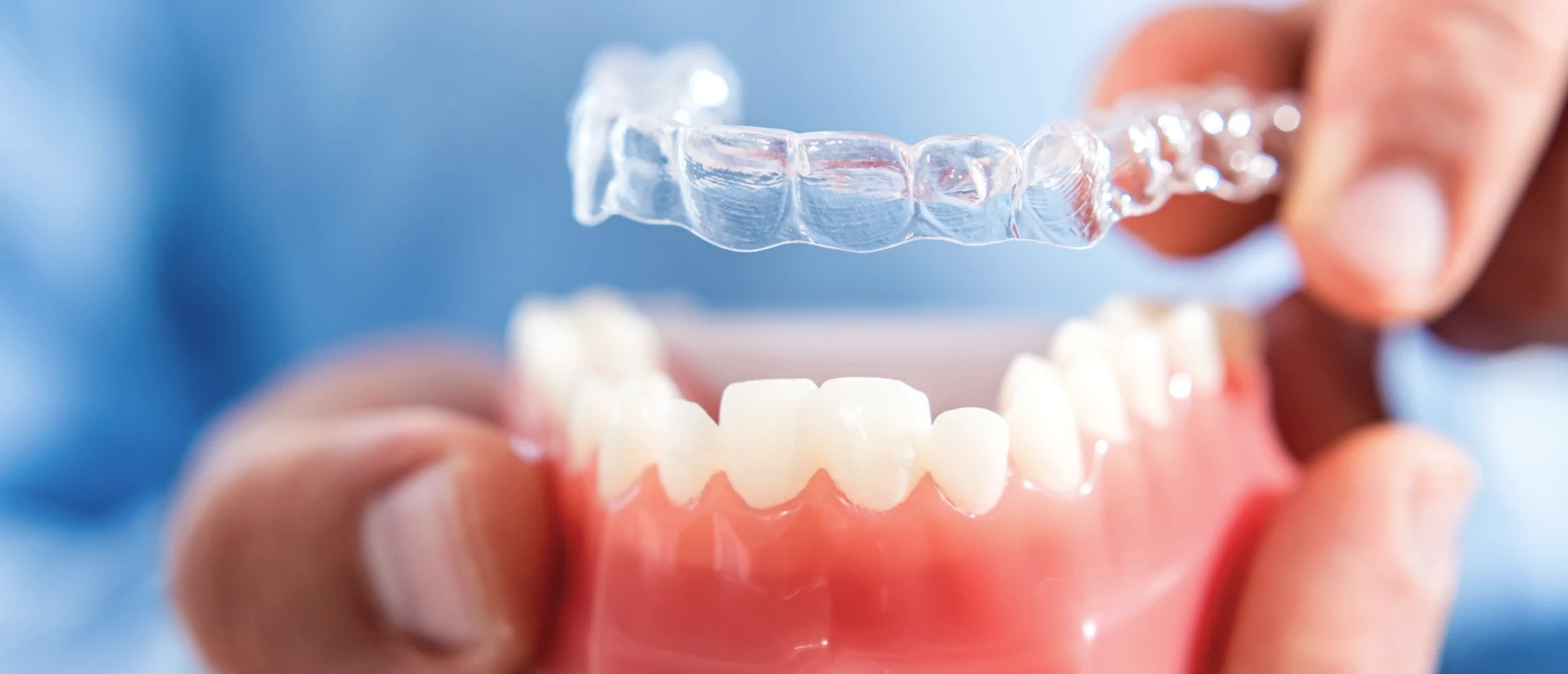 drs bluche drs blucheTraitement par gouttières invisiblesDrs BLUCHE & MONTANARO | Dentistes Lézignan-Corbières
