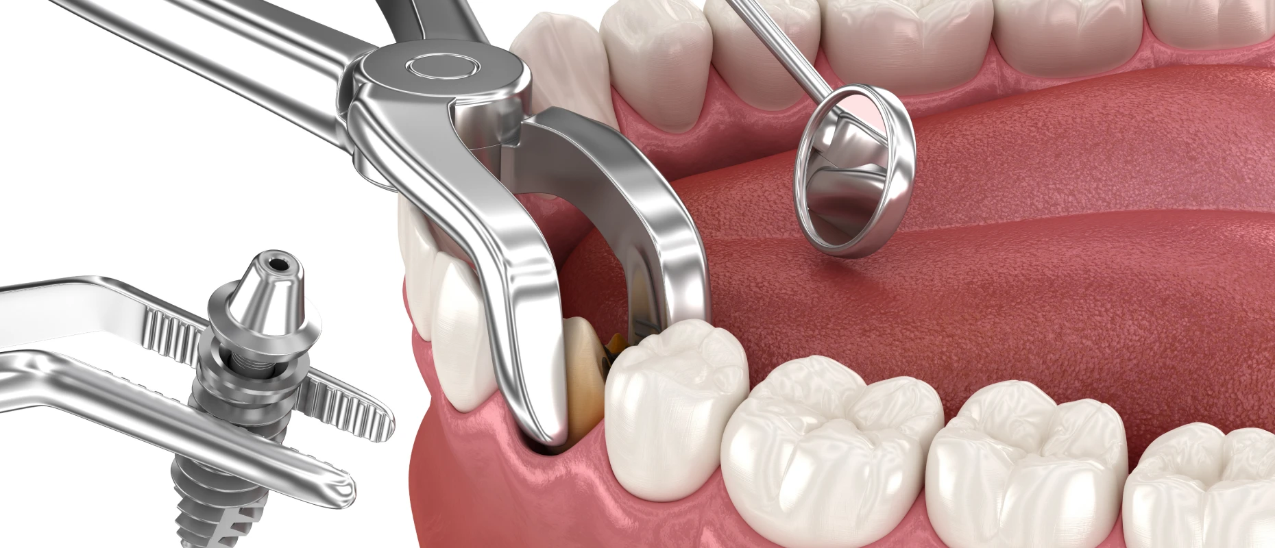 extraction implantation docteur bluche extraction implantation docteur blucheImplantologie immédiateDrs BLUCHE & MONTANARO | Dentistes Lézignan-Corbières