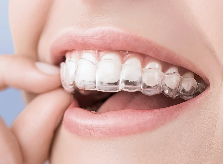 gouttieres adultes lezignan corbieres gouttieres adultes lezignan corbieresTraitement par gouttières invisiblesDrs BLUCHE & MONTANARO | Dentistes Lézignan-Corbières