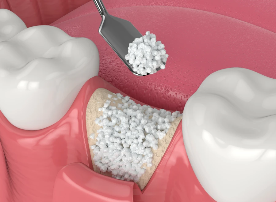 greffe osseuse dentiste bluche greffe osseuse dentiste blucheComblements osseuxDrs BLUCHE & MONTANARO | Dentistes Lézignan-Corbières