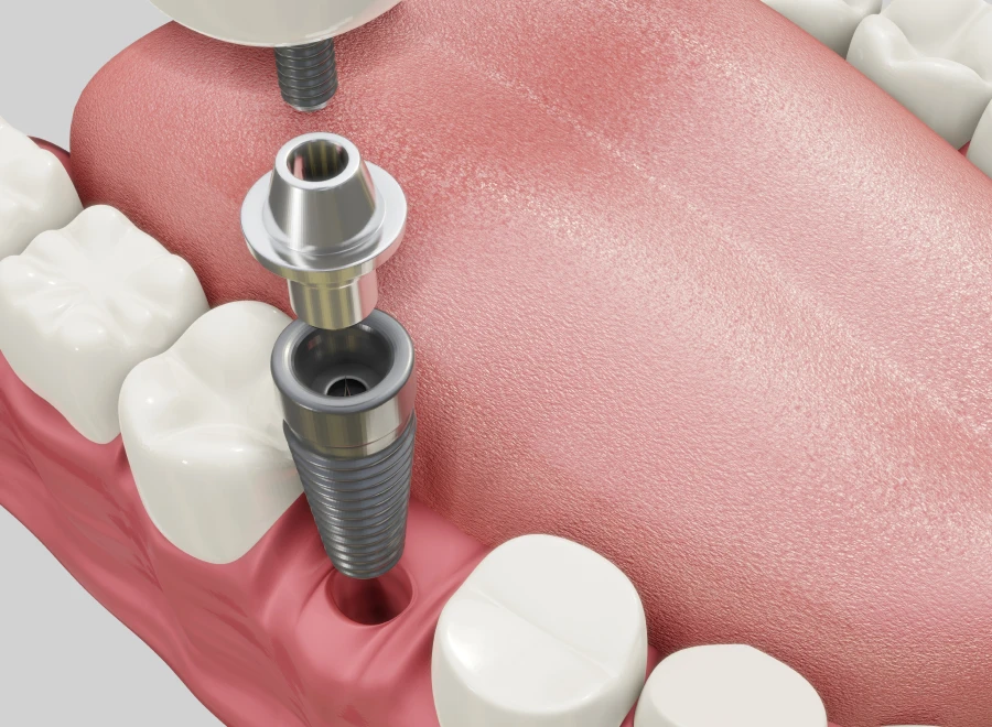 implantation immediate dentiste bluche implantation immediate dentiste blucheImplantologie immédiateDrs BLUCHE & MONTANARO | Dentistes Lézignan-Corbières