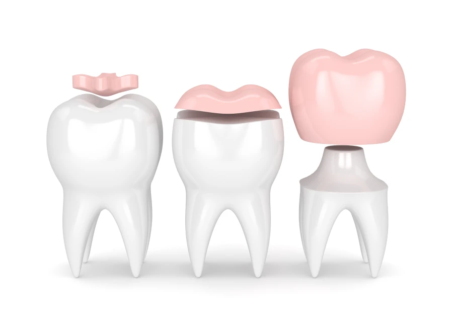 inlay onlay dentiste bluche inlay onlay dentiste blucheProthèses fixesDrs BLUCHE & MONTANARO | Dentistes Lézignan-Corbières