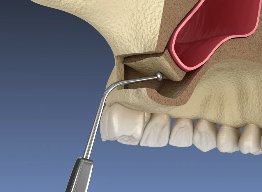 sinus lift dentiste bluche sinus lift dentiste blucheComblements osseuxDrs BLUCHE & MONTANARO | Dentistes Lézignan-Corbières